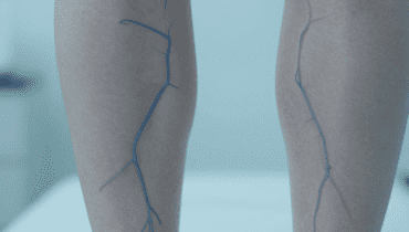 Vene varicose: il protocollo semplice alla cipolla e aceto di mele per alleviare le gambe quotidianamente