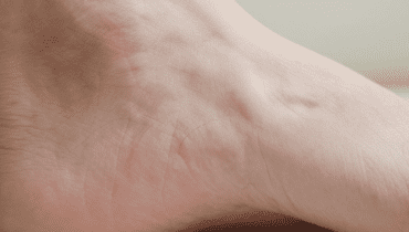 Talloni secchi e dolorosi: 5 rimedi naturali efficaci a base di ingredienti quotidiani Talloni secchi e dolorosi: 5 rimedi naturali efficaci a base di ingredienti quotidiani