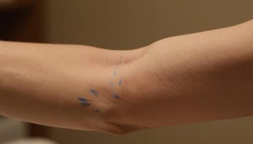 Vene evidenti la sera: la vasodilatazione termica e altre 6 cause fisiologiche spiegate