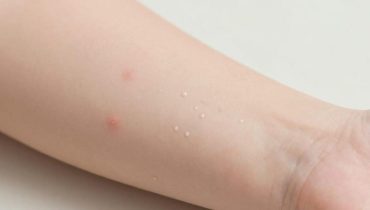 Mollusco contagioso: queste piccole protuberanze perlacee sulla pelle dei bambini scompaiono da sole in 6-12 mesi