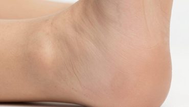 Talloni screpolati: 5 ingredienti quotidiani (cipolla, banana, aloe vera) che ripristinano naturalmente la morbidezza dei piedi